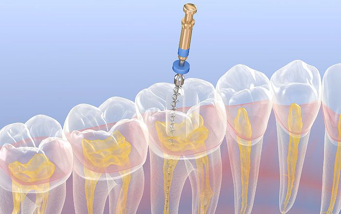 クラックトゥース症候群の原因:根管治療により歯の神経を取ったことがある