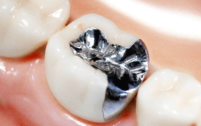 クラックトゥース症候群の原因:金属製の詰め物が入っている