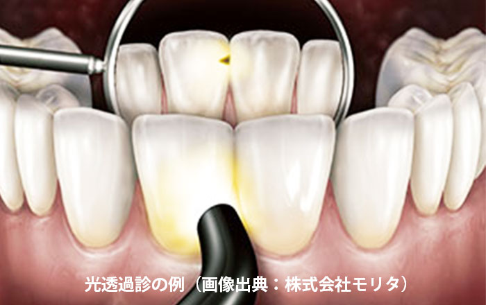 クラックトゥース症候群の検査法:光透過診を行う