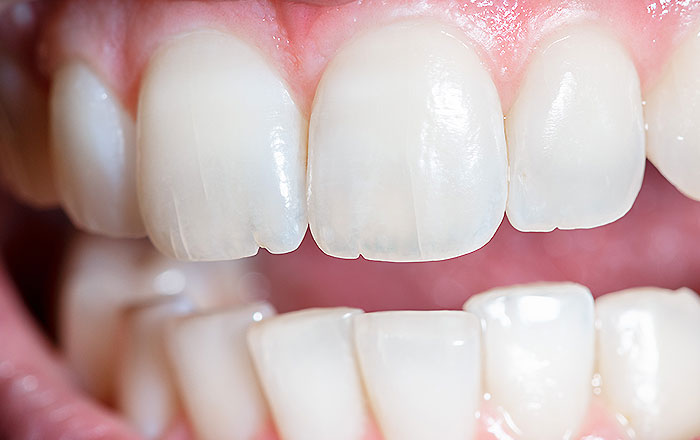 ホワイトニング後にしま模様が現れる原因：歯のヒビ