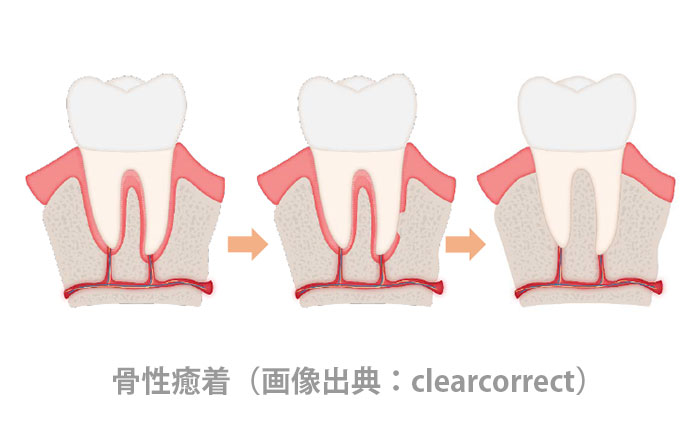 年齢が矯正治療に与える5つの影響：歯が動かない骨性癒着のリスクがある