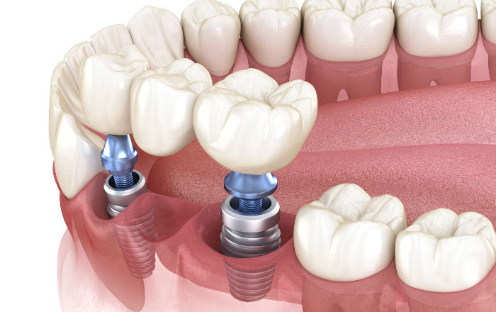年齢が矯正治療に与える5つの影響：ブリッジやインプラントへの配慮が必要