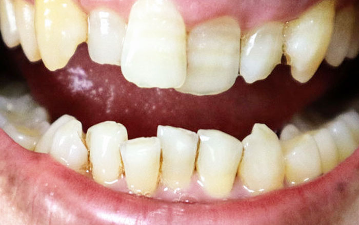 顔が左右非対称になる理由：歯並び・噛み合わせのズレ