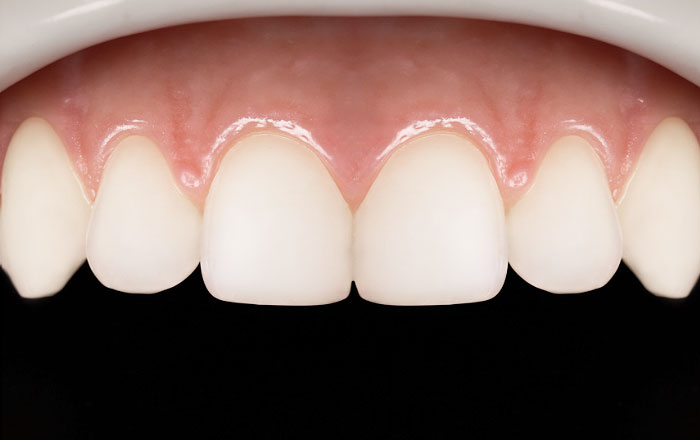 歯周病の予防効果がある