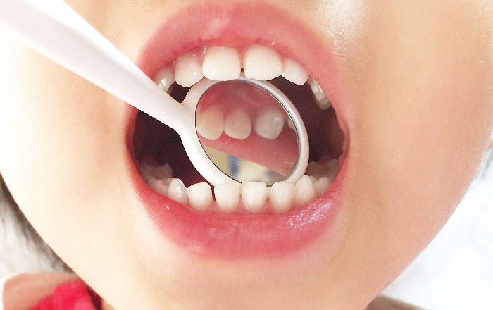 子どもの歯ぎしりの原因