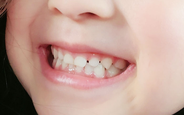 注意した方が良い、歯ぎしりがお子さんの歯に与える影響:咬耗