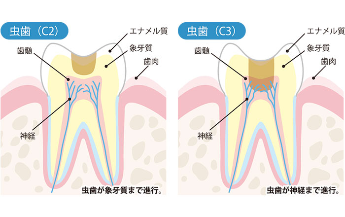 象牙質まで進行した虫歯は従来の治療が必要