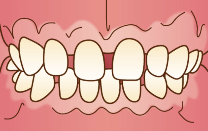 出っ歯・すきっ歯（上顎前突・空隙歯列）