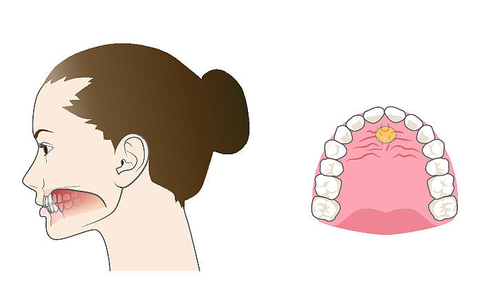 安静時の正しい舌の位置は、舌先が上前歯の少し後ろにあるふくらみ（スポット）に軽く触れ、舌全体が上顎にぴったりと収まっている状態