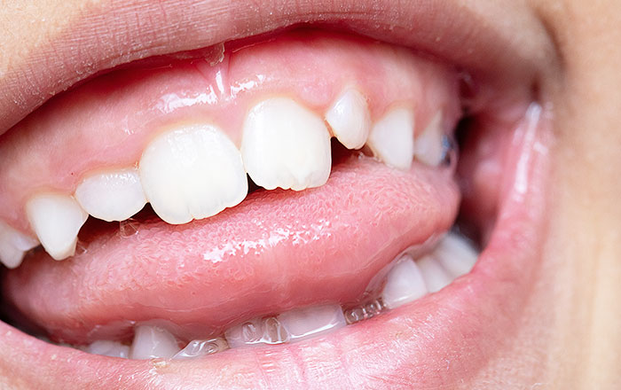 舌圧が歯並び与える影響