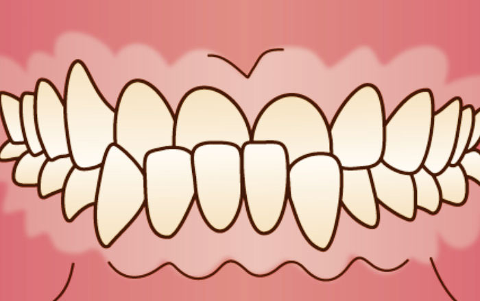 受け口（反対咬合・下顎前突）