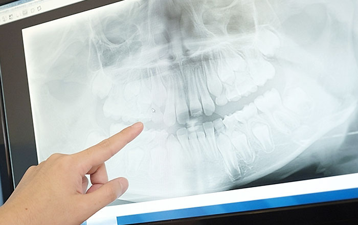 ダイアグノデントペンとレントゲンの違い