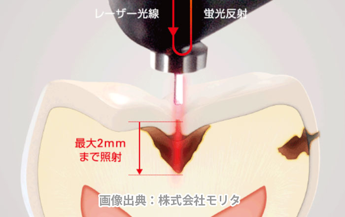 ダイアグノデントペンで虫歯の疑いを数値で確認する仕組み