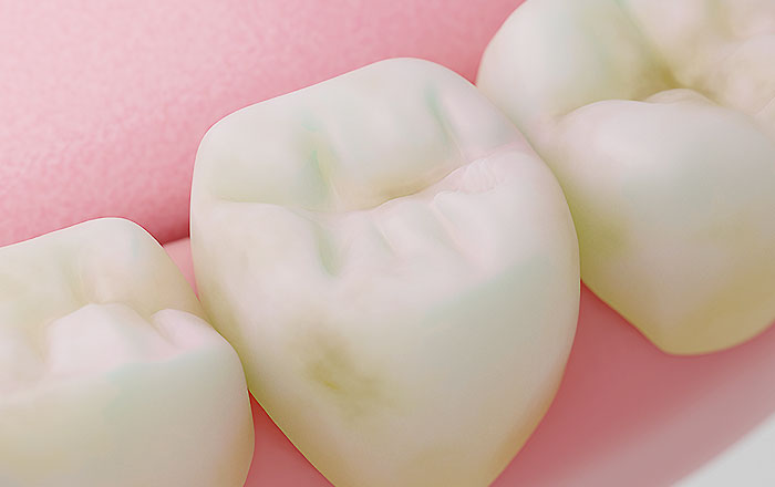 ダイアグノデントペンが得意とする虫歯の発見部位