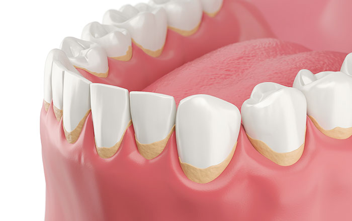 虫歯も歯周病もプラークが関係するのは共通点