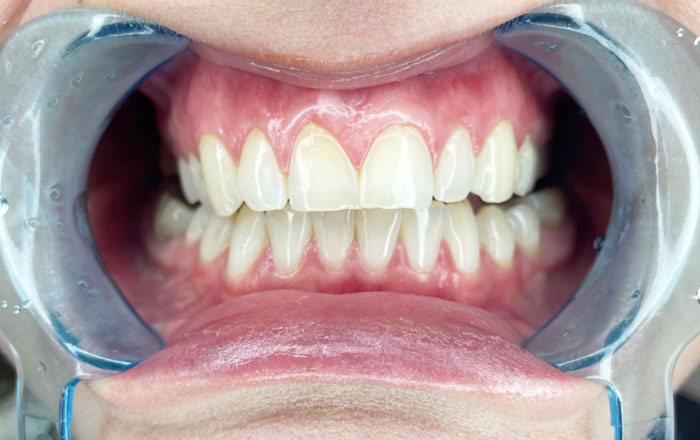 ホワイトニング後にしま模様が現れる原因：脱水