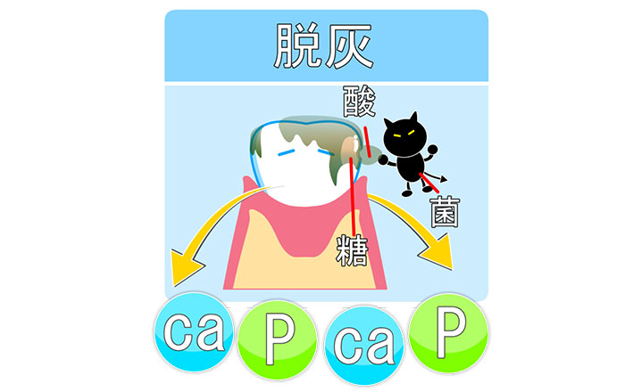 ホワイトニング後に斑点模様が現れる原因：脱灰