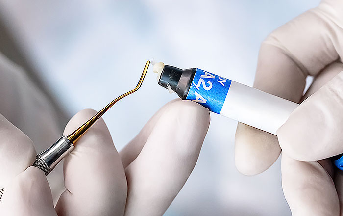 ホワイトニング後の色ムラ（斑点模様）への対処法：コンポジットレジン充填