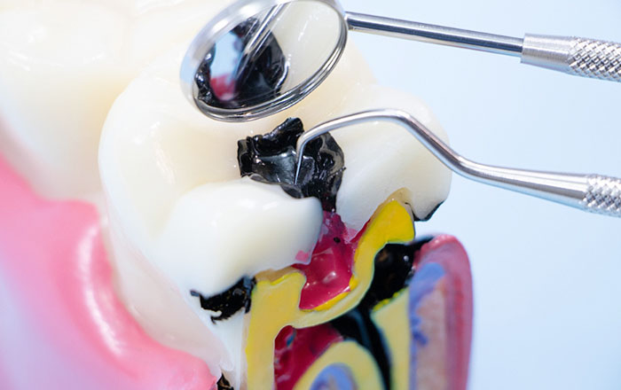 ケラチンの歯科治療への応用:虫歯治療