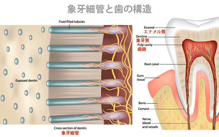 ケラチンの歯科治療への応用:知覚過敏の治療