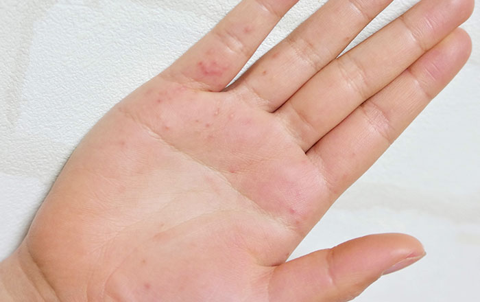 歯科麻酔の注意点：アレルギー