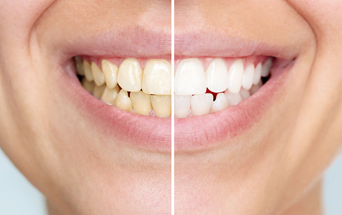 歯のクリーニングのおすすめの頻度：着色汚れ（ステイン）が気になる方は2～3ヶ月に1回