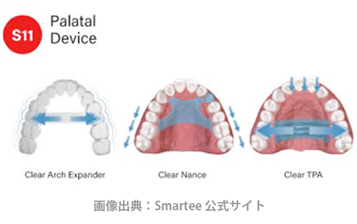 スマーティー矯正のメリット:上顎の横幅も広げられる