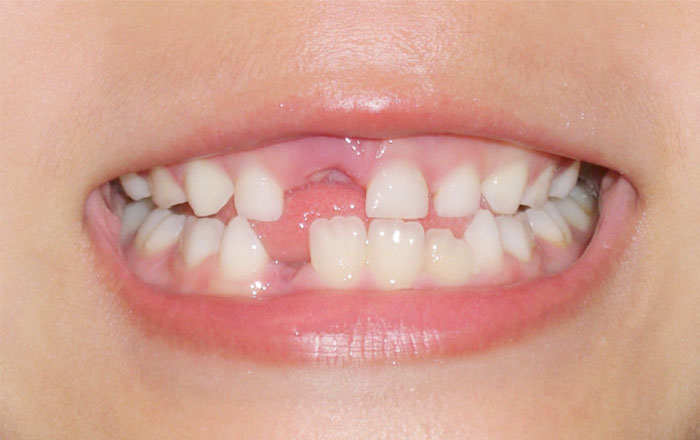 Smartee Teen(スマーティー ティーン)