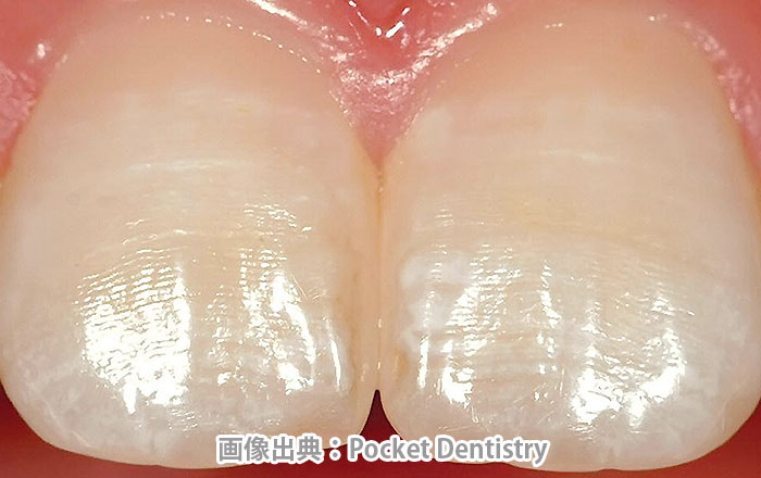 周波条と呼ばれる歯の成長線
