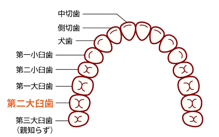 第二大臼歯が抜けた場合、親知らずを土台にしますが、親知らずが生えていない場合は前2本の歯（小臼歯、第一大臼歯）を使った延長ブリッジを用いることになります。