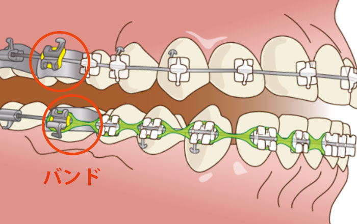 歯間分離（セパレーション）とは歯の間にすき間を作る処置