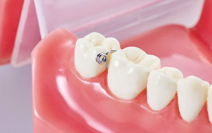歯間分離ですき間を作る3つの方法：スプリングをかける